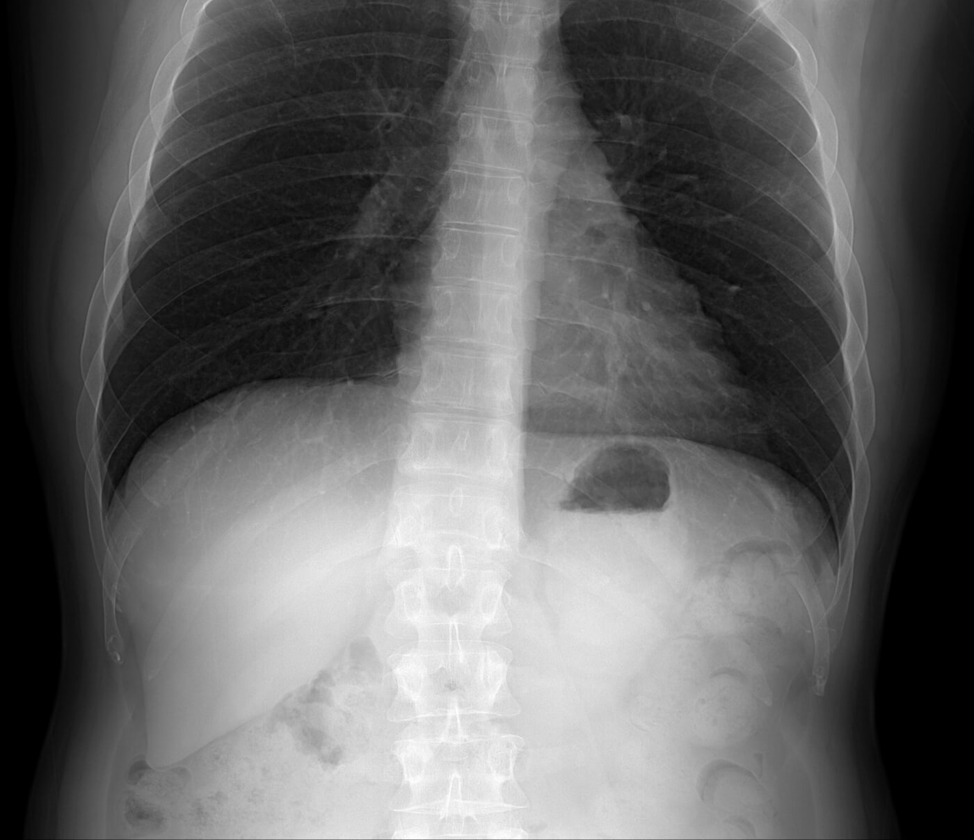 Photon Counting Xray Imaging and Lung CT Direct Conversion